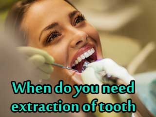 When do you need extraction of tooth